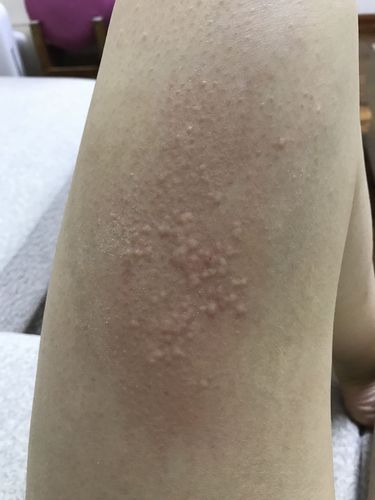 拍一拍识别皮肤病百度